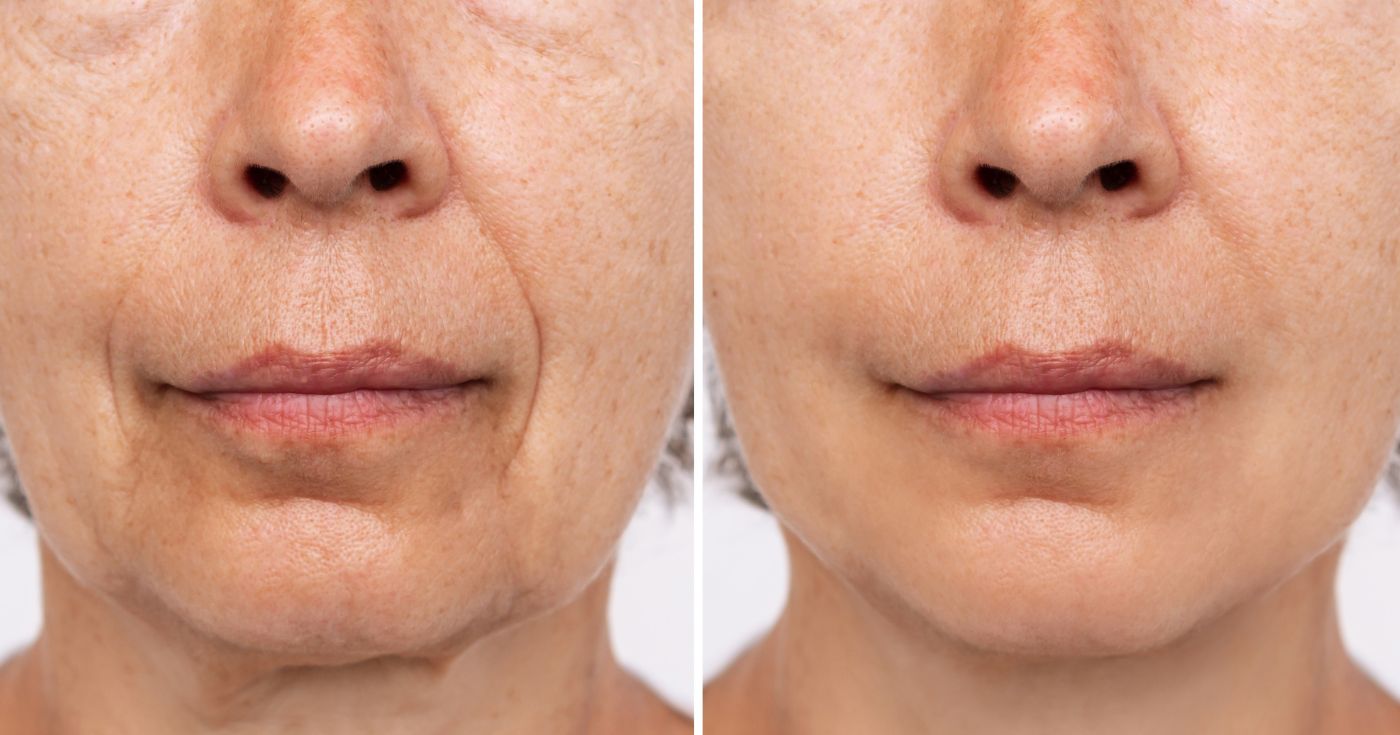 Rides profondes : ces soins (avec ou sans injection) promettent un avant/après bluffant selon Beauté Test