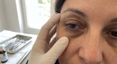 Ces cernes qui ne partent jamais : cette méthode approuvée par les dermatologues éclaircit le regard en quelques séances