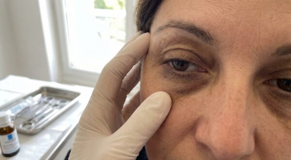 Anti-cernes : cette méthode approuvée par les dermatologues éclaircit le regard en seulement quelques séances
