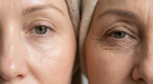 Rides du contour de l’œil : acide hyaluronique ou collagène, ce choix d’actif peut métamorphoser votre regard