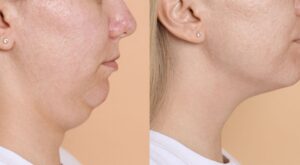 Double menton après 40 ans : cette astuce de pro avec votre téléphone stoppe l&rsquo;affaissement