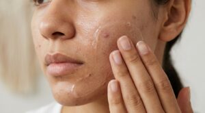 Peau grasse, boutons après le soleil : ces 9 protections SPF non comédogènes validées par les dermatos évitent les éruptions