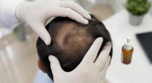 Ce médicament viral contre la chute de cheveux affole TikTok : pourquoi son usage préventif inquiète autant les dermatologues